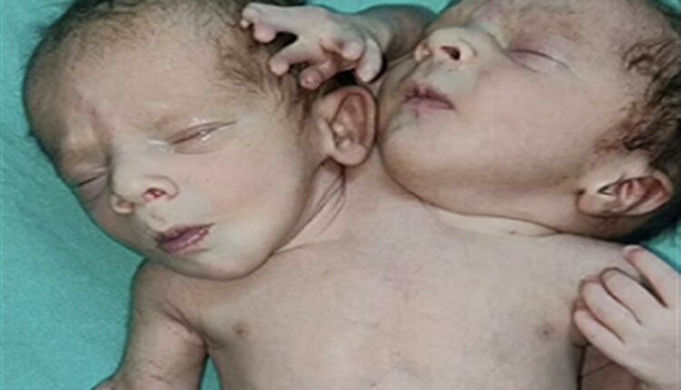 ولله في خلقه شؤون..ولادة طفل برأسين وقلبين وثلاث أذرع (صور)