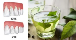 طرق علاج آلام اللثة في المنزل