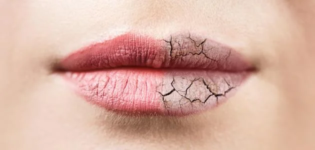 جفاف الشفاه في الشتاء: أسبابه وطرق الوقاية منه