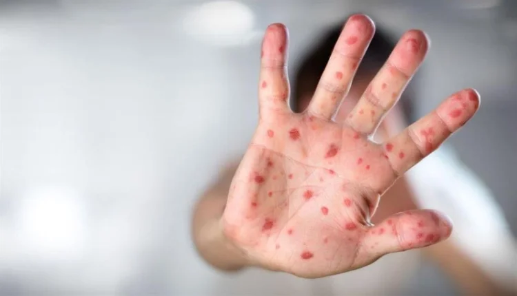 عدوى منتشرة تدفع وزارة الصحة لإصدار بلاغ