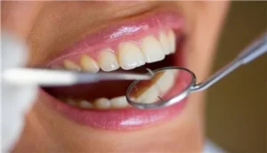 أطعمة وعصائر تسبب تآكل الأسنان