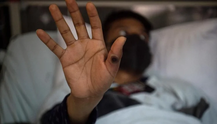 أمريكا الجنوبية في حالة تأهب لمواجهة خطر جدري القردة